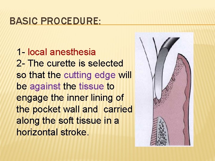 BASIC PROCEDURE: 1 - local anesthesia 2 - The curette is selected so that