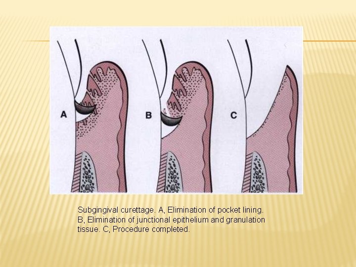 Subgingival curettage. A, Elimination of pocket lining. B, Elimination of junctional epithelium and granulation