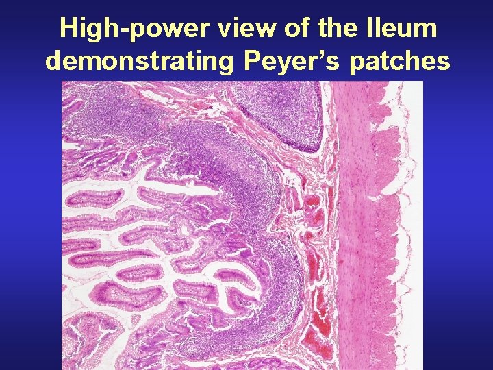High-power view of the Ileum demonstrating Peyer’s patches 