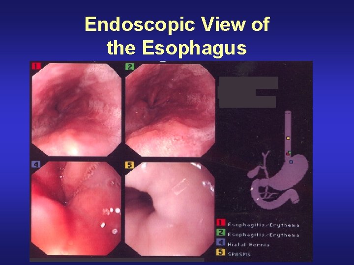 Endoscopic View of the Esophagus 