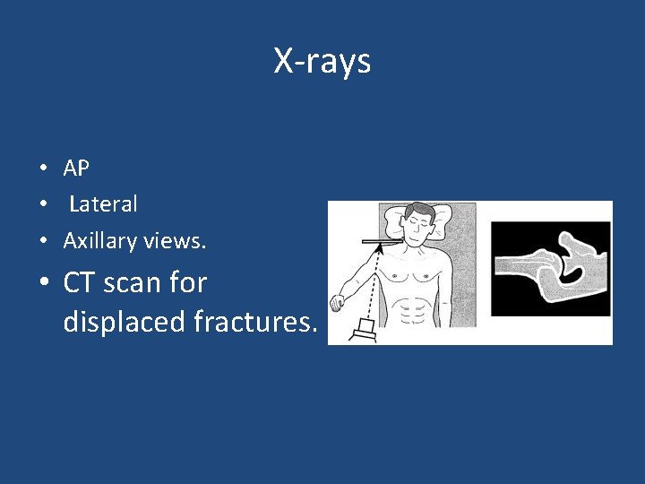 X-rays • AP • Lateral • Axillary views. • CT scan for displaced fractures.