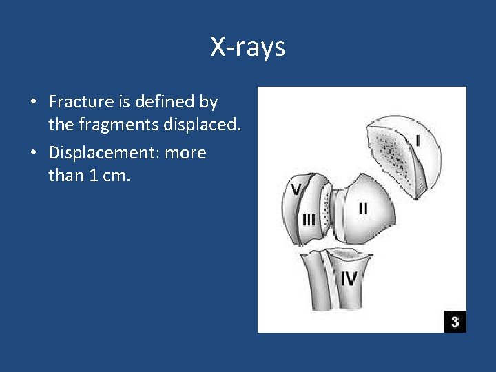 X-rays • Fracture is defined by the fragments displaced. • Displacement: more than 1