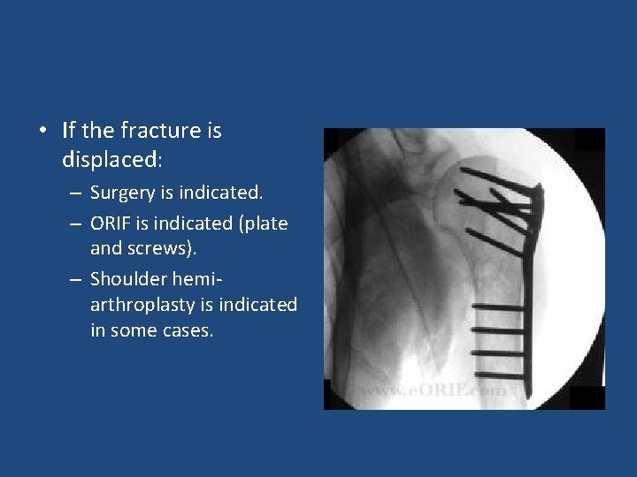  • If the fracture is displaced: – Surgery is indicated. – ORIF is