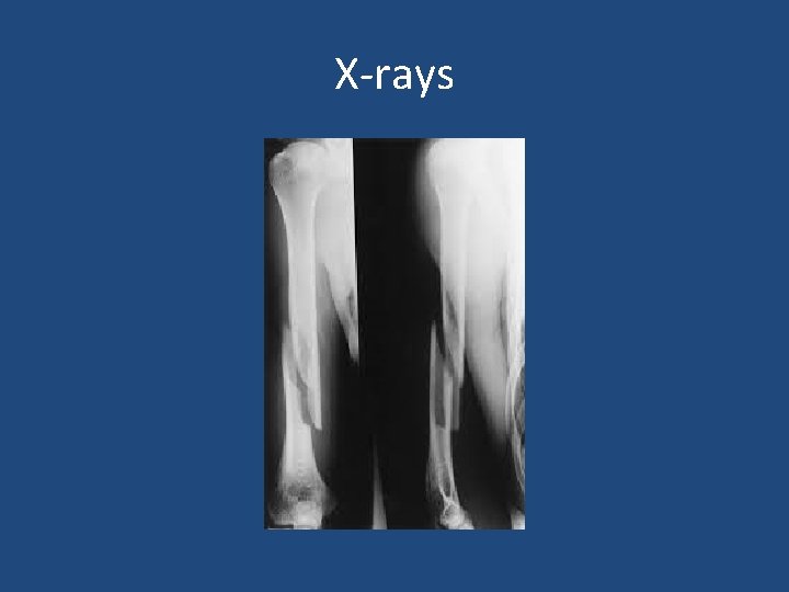 X-rays 