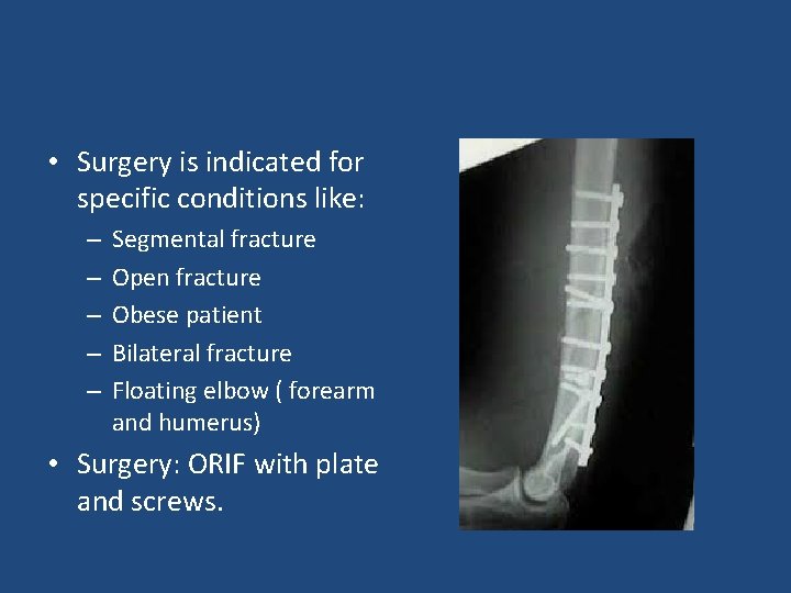  • Surgery is indicated for specific conditions like: – – – Segmental fracture