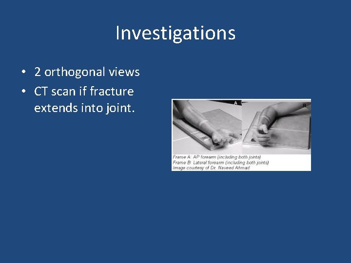 Investigations • 2 orthogonal views • CT scan if fracture extends into joint. 