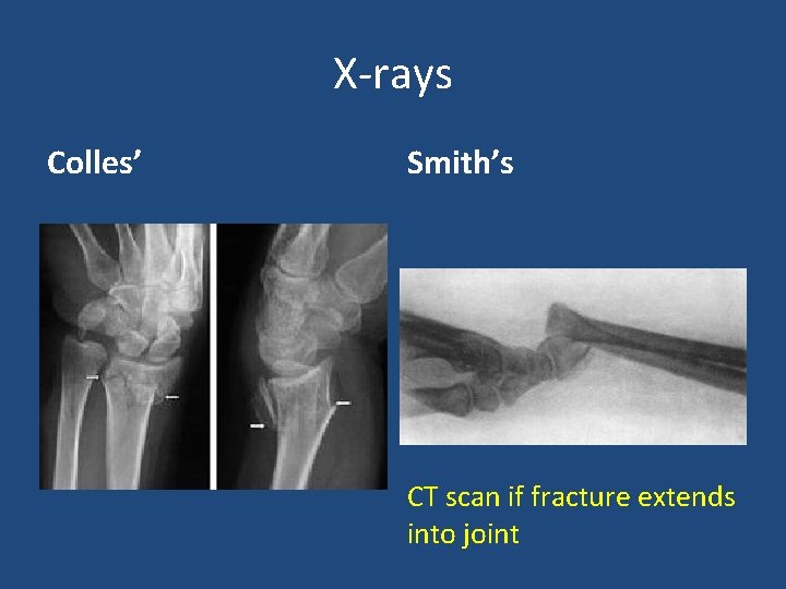 X-rays Colles’ Smith’s CT scan if fracture extends into joint 