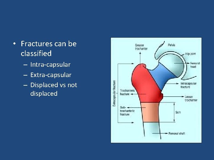  • Fractures can be classified – Intra-capsular – Extra-capsular – Displaced vs not