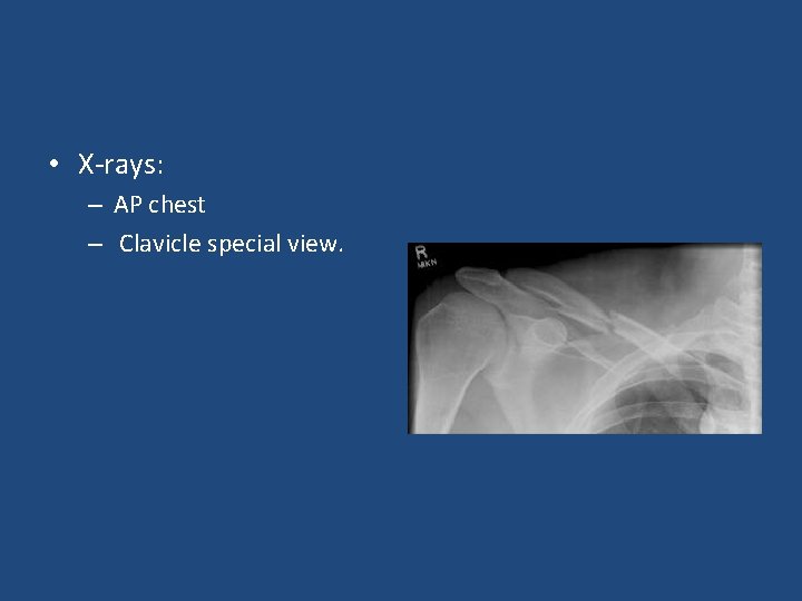 • X-rays: – AP chest – Clavicle special view. 