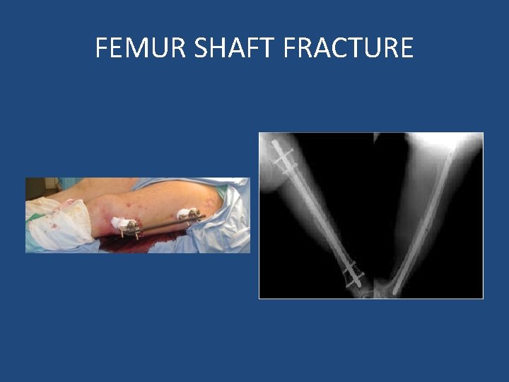 FEMUR SHAFT FRACTURE 