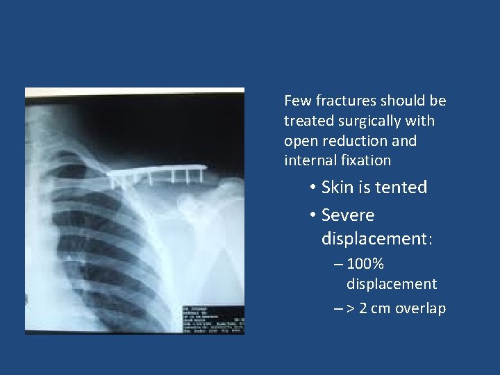 Few fractures should be treated surgically with open reduction and internal fixation • Skin