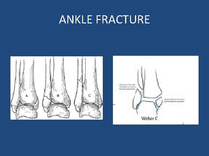 ANKLE FRACTURE 