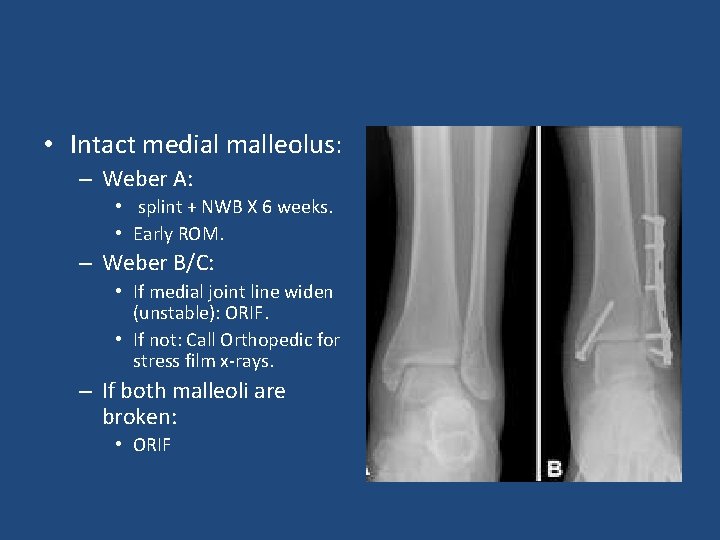  • Intact medial malleolus: – Weber A: • splint + NWB X 6