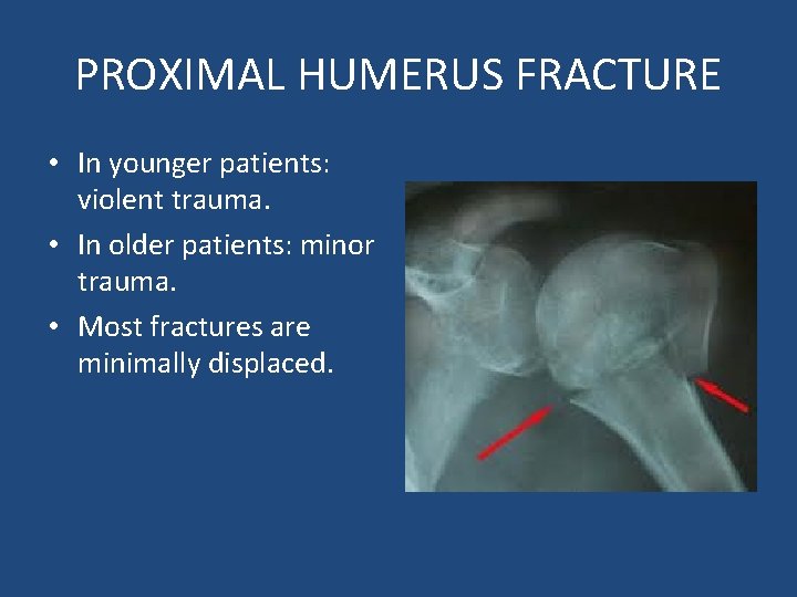 PROXIMAL HUMERUS FRACTURE • In younger patients: violent trauma. • In older patients: minor