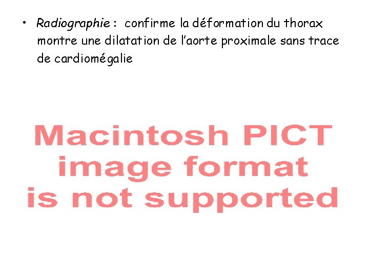  • Radiographie : confirme la déformation du thorax montre une dilatation de l’aorte