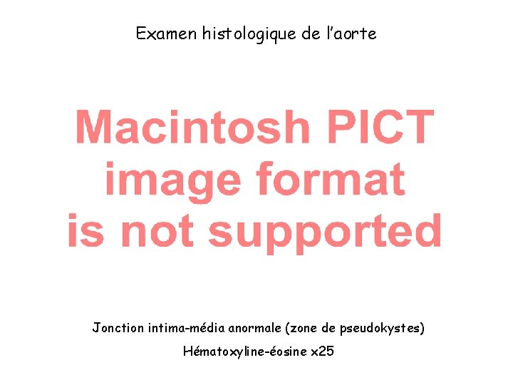 Examen histologique de l’aorte Jonction intima-média anormale (zone de pseudokystes) Hématoxyline-éosine x 25 