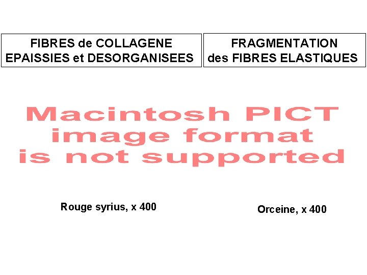 FIBRES de COLLAGENE EPAISSIES et DESORGANISEES Rouge syrius, x 400 FRAGMENTATION des FIBRES ELASTIQUES