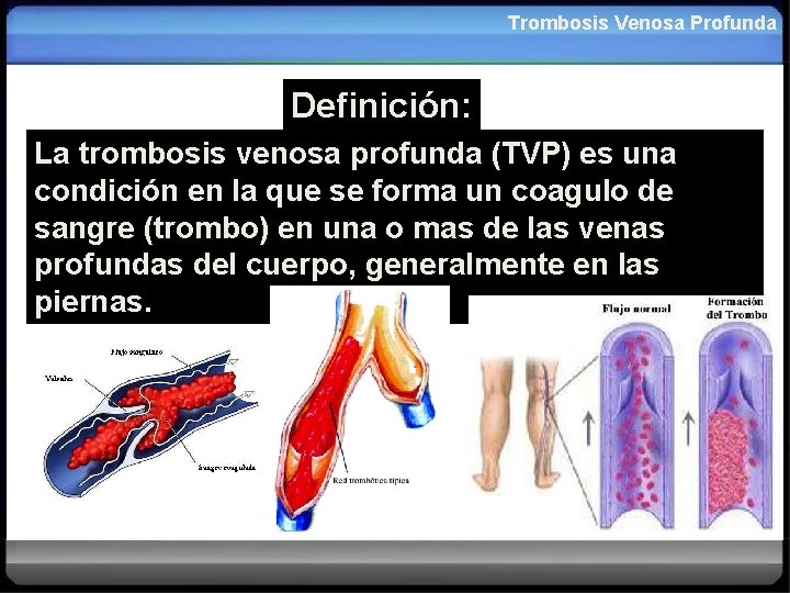 Trombosis Venosa Profunda Definición: La trombosis venosa profunda (TVP) es una condición en la