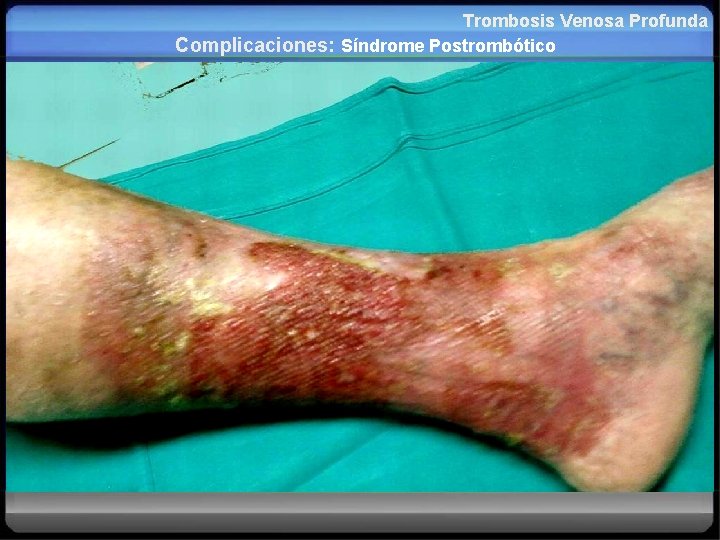 Trombosis Venosa Profunda Complicaciones: Síndrome Postrombótico 