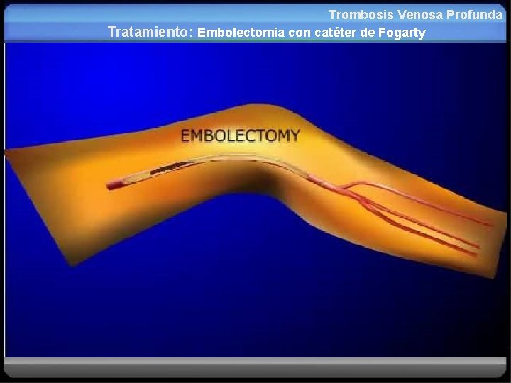 Trombosis Venosa Profunda Tratamiento: Embolectomia con catéter de Fogarty 