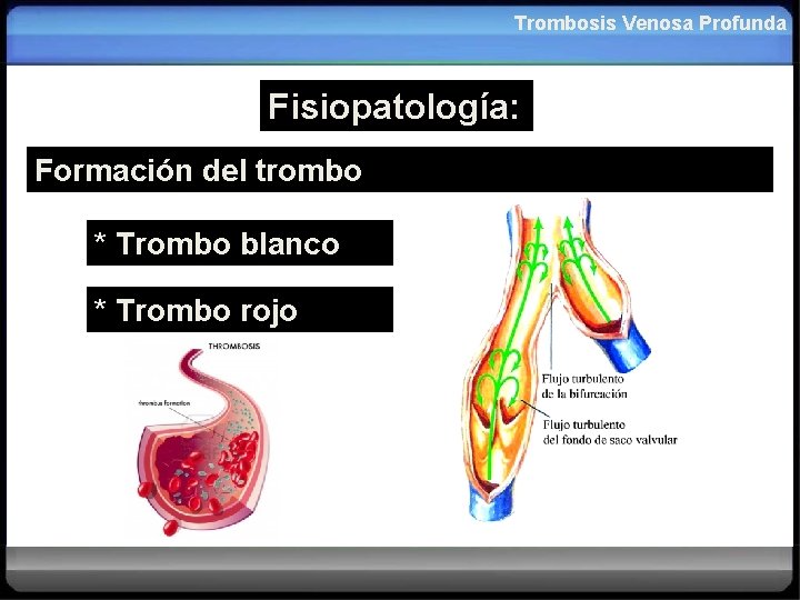 Trombosis Venosa Profunda Fisiopatología: Formación del trombo * Trombo blanco * Trombo rojo 