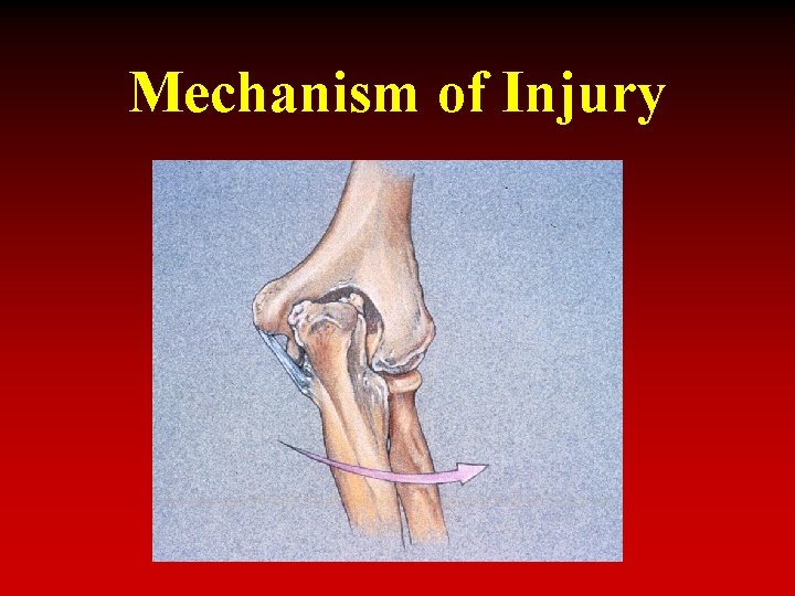 Mechanism of Injury 