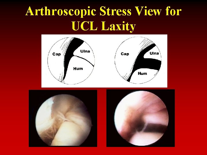 Arthroscopic Stress View for UCL Laxity 