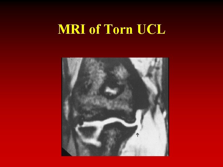 MRI of Torn UCL 