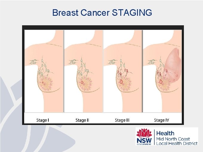 Breast Cancer STAGING 