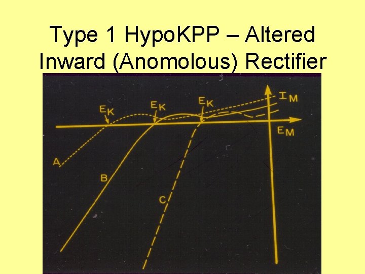 Type 1 Hypo. KPP – Altered Inward (Anomolous) Rectifier 