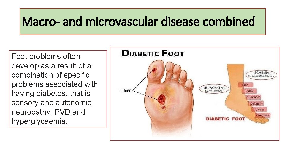 Macro- and microvascular disease combined Foot problems often develop as a result of a