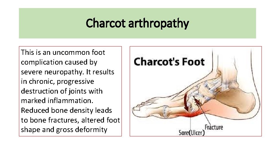 Charcot arthropathy This is an uncommon foot complication caused by severe neuropathy. It results