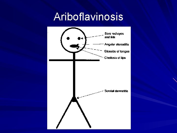 Ariboflavinosis 