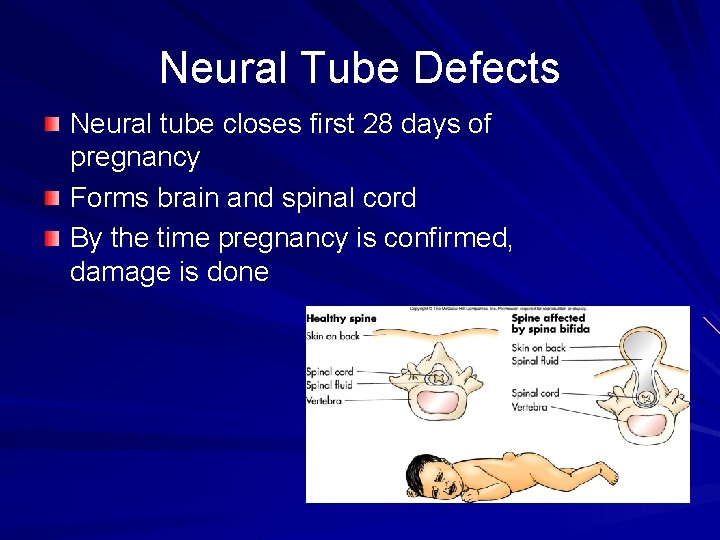 Neural Tube Defects Neural tube closes first 28 days of pregnancy Forms brain and