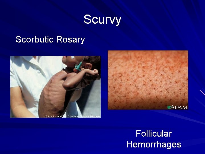 Scurvy Scorbutic Rosary Follicular Hemorrhages 