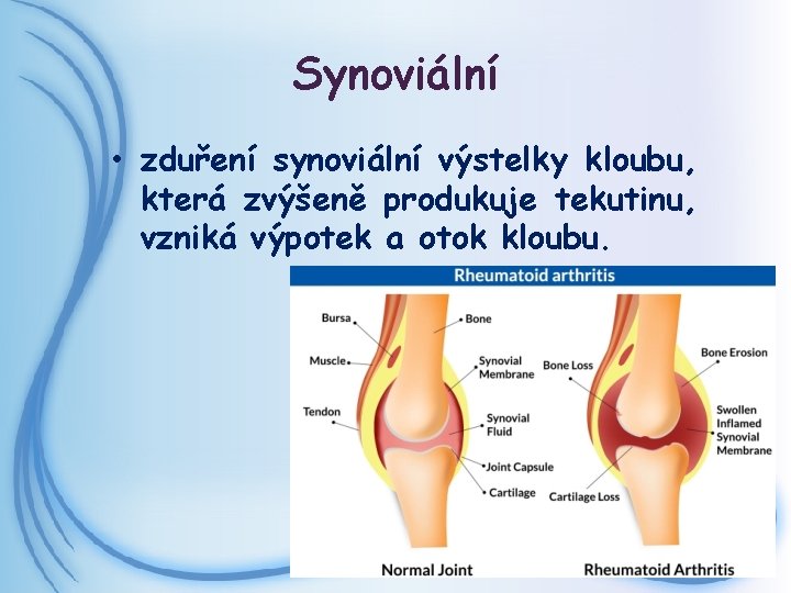 Synoviální • zduření synoviální výstelky kloubu, která zvýšeně produkuje tekutinu, vzniká výpotek a otok