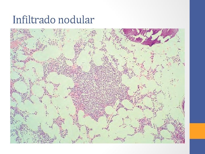 Infiltrado nodular 