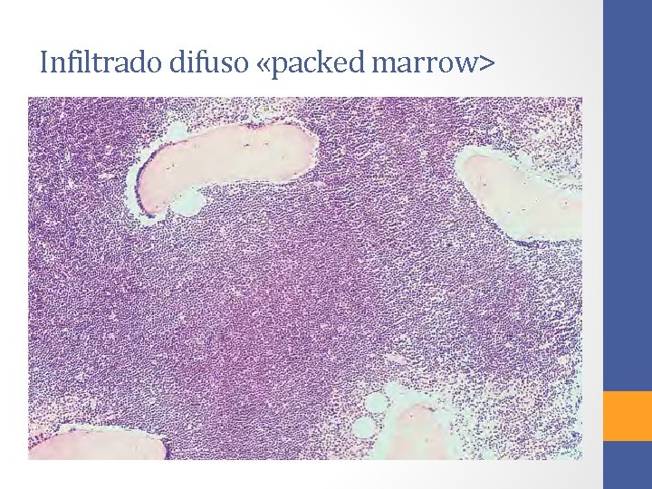 Infiltrado difuso «packed marrow> 