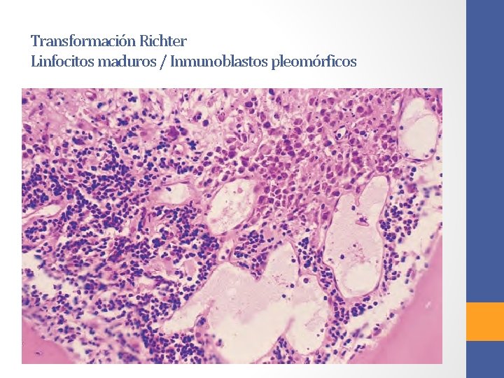 Transformación Richter Linfocitos maduros / Inmunoblastos pleomórficos 