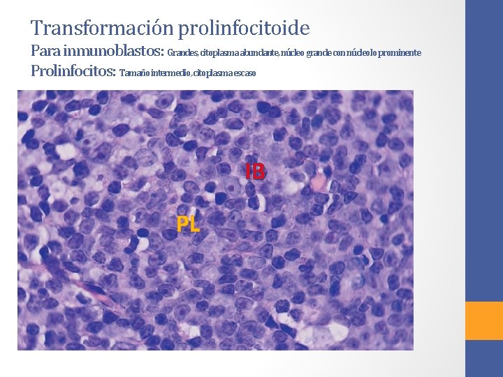 Transformación prolinfocitoide Para inmunoblastos: Grandes, citoplasma abundante, núcleo grande con núcleolo prominente Prolinfocitos: Tamaño