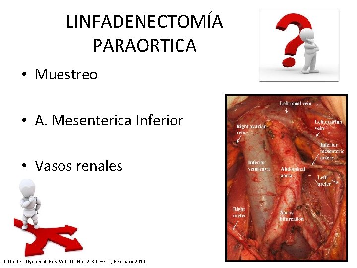 LINFADENECTOMÍA PARAORTICA • Muestreo • A. Mesenterica Inferior • Vasos renales J. Obstet. Gynaecol.