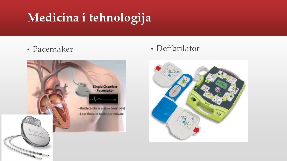 Medicina i tehnologija • Pacemaker • Defibrilator 