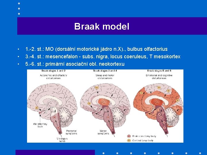 Braak model • • • 1. -2. st. : MO (dorsální motorické jádro n.