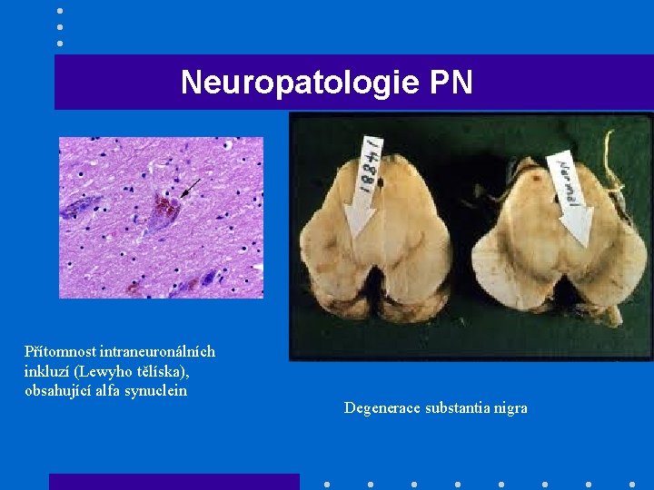 Neuropatologie PN Přítomnost intraneuronálních inkluzí (Lewyho tělíska), obsahující alfa synuclein Degenerace substantia nigra 
