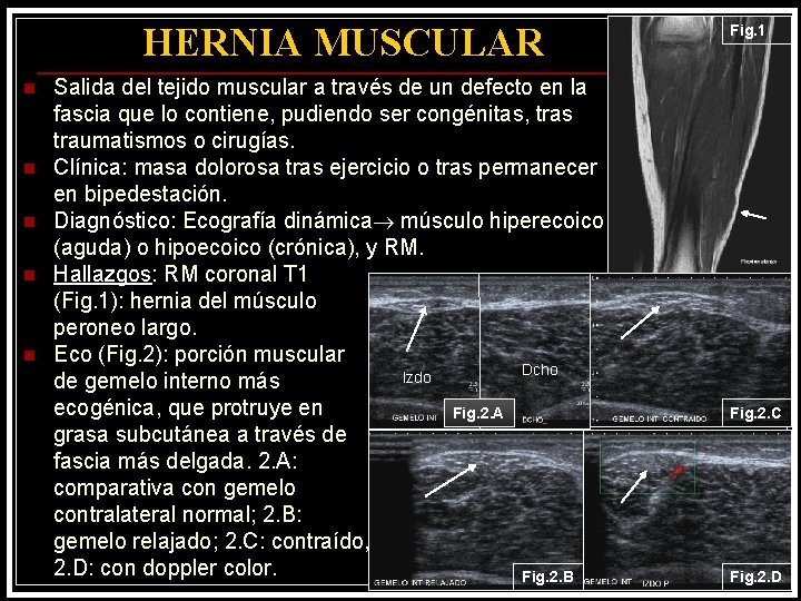 HERNIA MUSCULAR n n n Salida del tejido muscular a través de un defecto