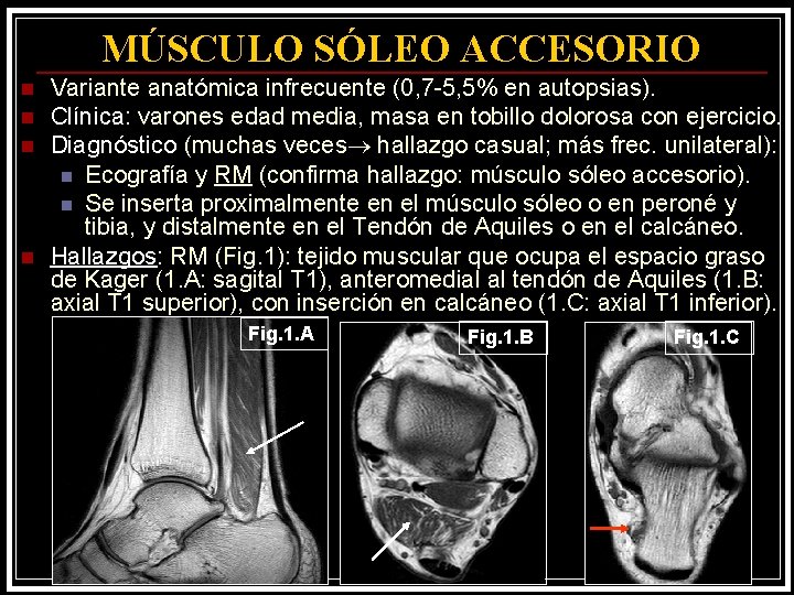 MÚSCULO SÓLEO ACCESORIO n n Variante anatómica infrecuente (0, 7 -5, 5% en autopsias).