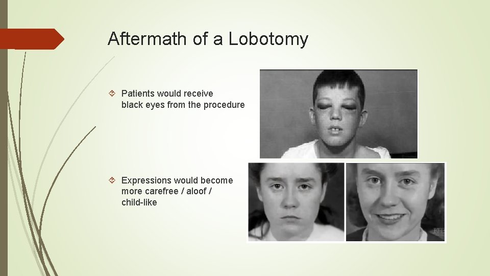 Aftermath of a Lobotomy Patients would receive black eyes from the procedure Expressions would
