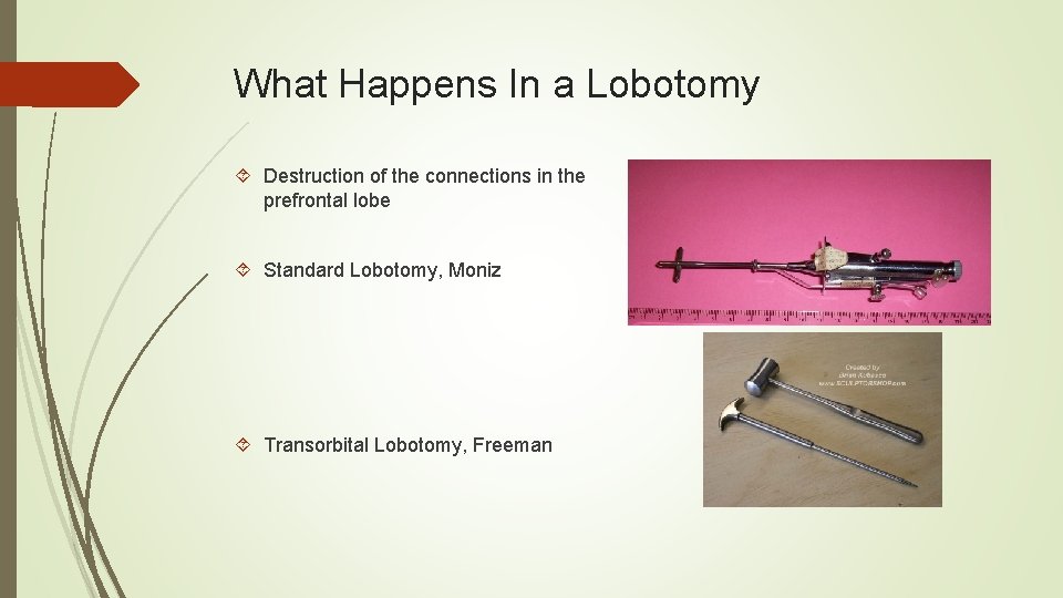What Happens In a Lobotomy Destruction of the connections in the prefrontal lobe Standard