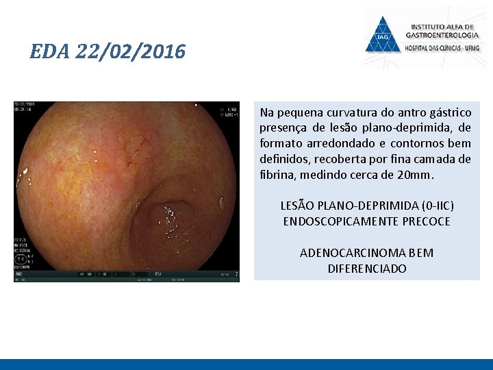 EDA 22/02/2016 Na pequena curvatura do antro gástrico presença de lesão plano-deprimida, de formato