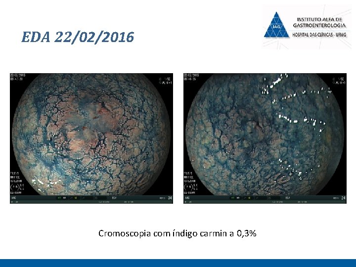 EDA 22/02/2016 Cromoscopia com índigo carmin a 0, 3% 